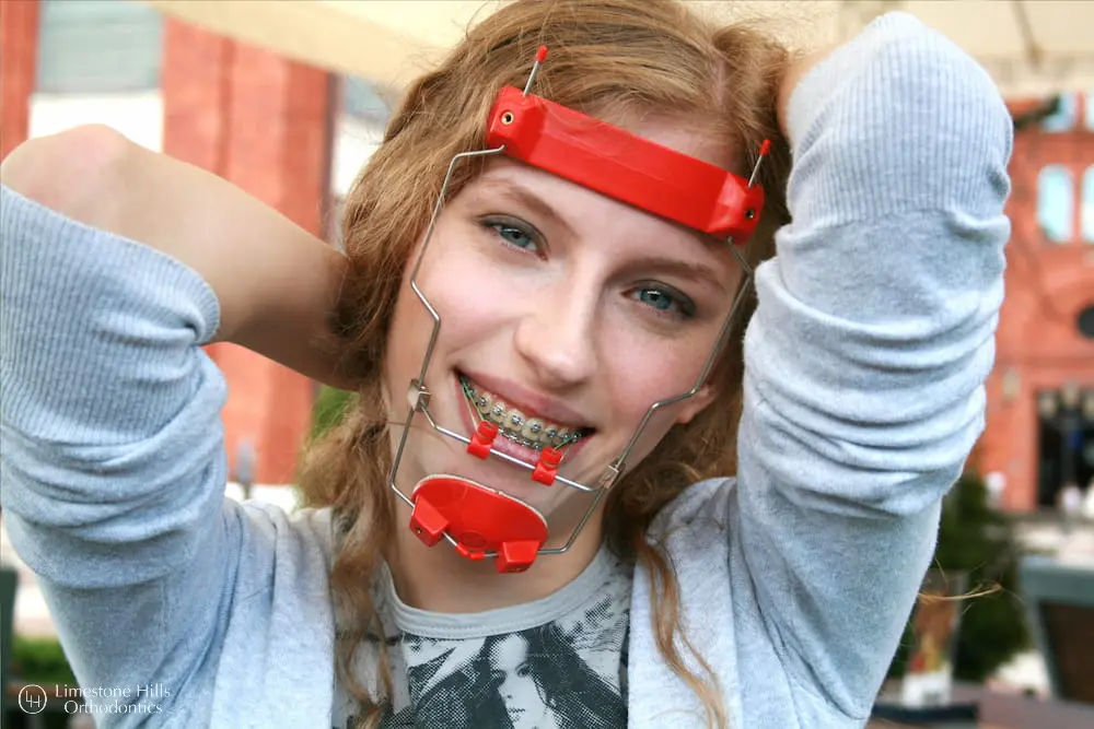 a woman smiling with red reverse pull headgear braces on her face