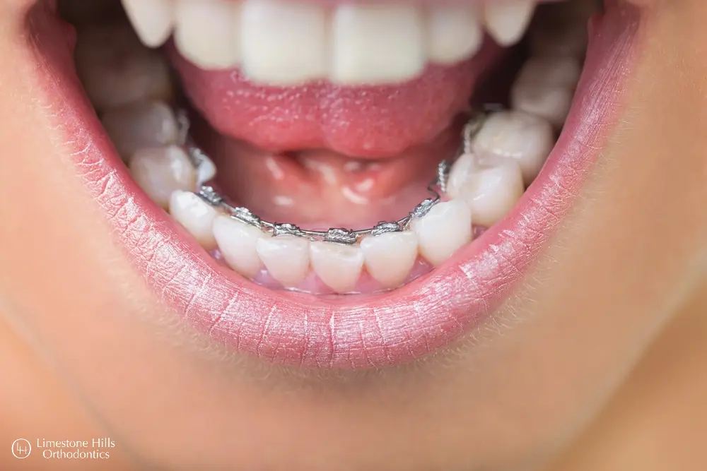 a person's mouth with Lingual Braces vs Invisalign