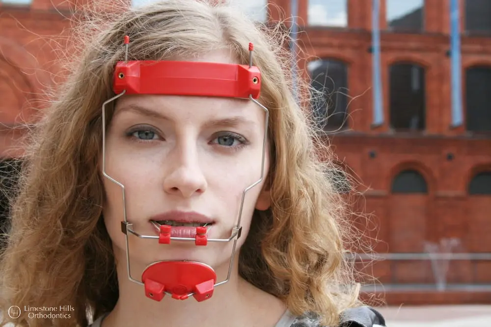 a woman smiling with red reverse pull headgear braces on her face