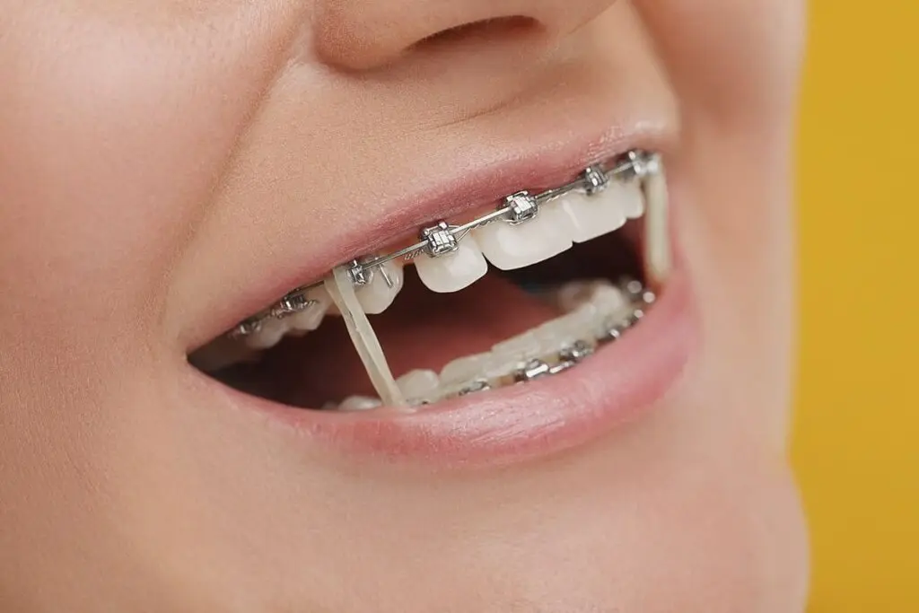 braces rubber band and its consequences of Not Wearing Orthodontic Elastics