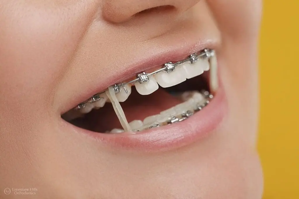 braces rubber band and its consequences of Not Wearing Orthodontic Elastics