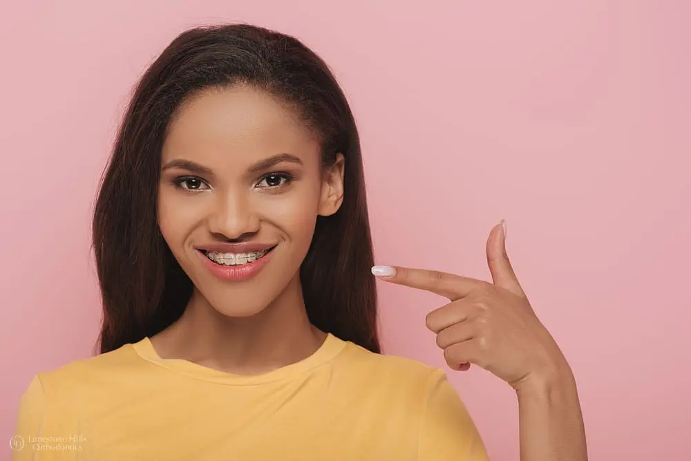 smiling african american girl pointing finger metal braces her teeth after asking about ""Will Braces Change My Face Shape?