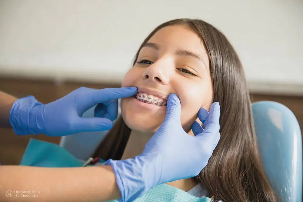 Teenage girl with metal braces being examined by a dentist wearing gloves because she knows that summer is Great Time to Start Invisalign or Braces