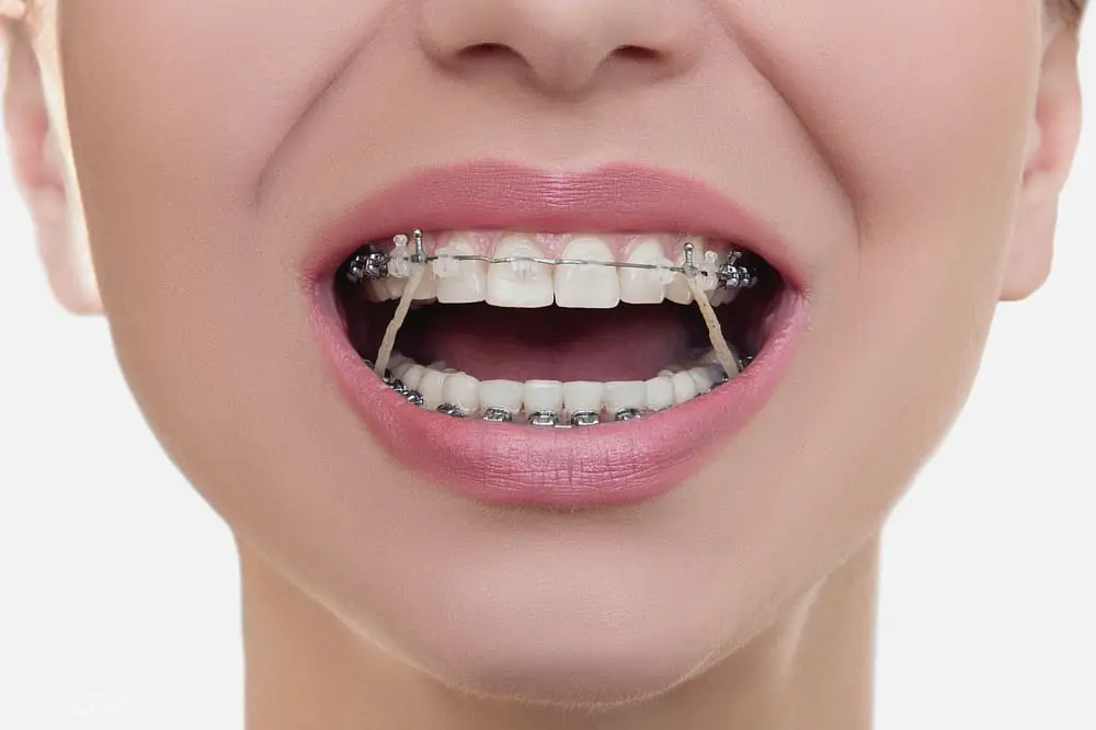 woman opening her mouth with orthodontic elastics after knowing the consequences of Not Wearing Orthodontic Elastics
