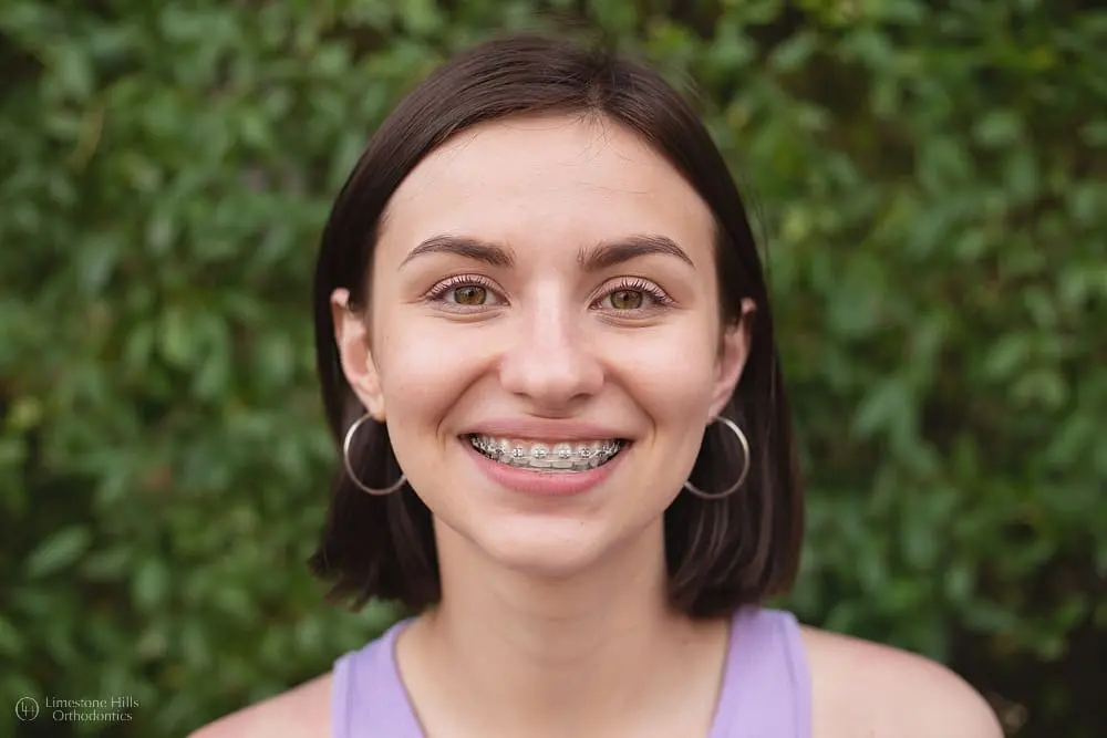 A close-up shot of a smiling young woman with braces, highlighting the importance of early orthodontic intervention for a healthy smile. The clinic name, Limestone Hills Orthodontics, and location, Austin, TX, are subtly referenced, suggesting their expertise in preventative and early orthodontic care.