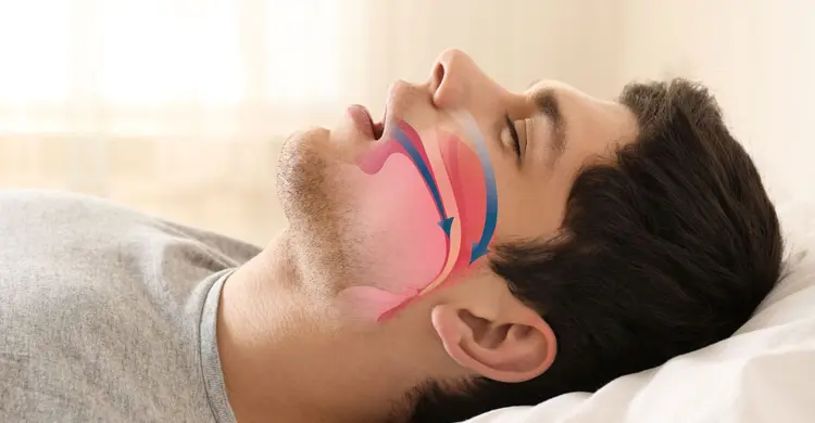A man, who appears to be of Caucasian ethnicity based on his features and complexion, is shown lying on his back with his mouth open. An overlay illustrates the potential airflow during mouth breathing, with a blue arrow indicating air entering the mouth and traveling down the throat. This image can be used to discuss the implications of mouth breathing, which Limestone Hills Orthodontics in Austin, TX, considers in relation to orthodontic health.