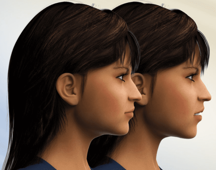 Lateral view before and after maxillary impaction jaw surgery for Treatment of Gummy Smile and Overbite at Limestone Hills Orthodontics in Austin, TX.