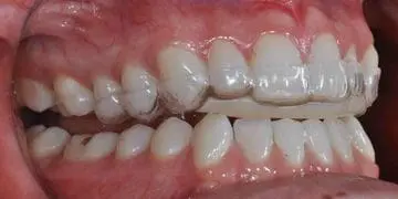 Close-up of teeth wearing a full coverage mouth guard for TMJ disorder relief. Limestone Hills Orthodontics in Austin, TX, offers advanced TMJ mouth guard solutions