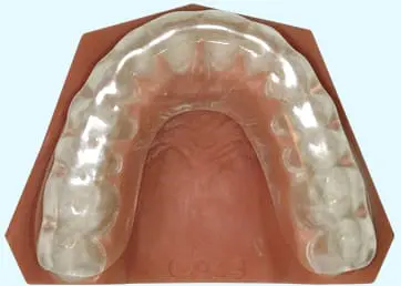 Illustration of an anterior mouth guard for TMJ disorder treatment. Limestone Hills Orthodontics in Austin, TX, provides customized TMJ mouth guards