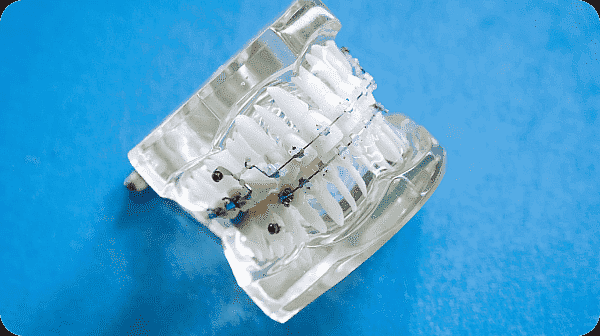 A clear plastic dental model displaying teeth with metal braces and archwires on a blue background, illustrating archwire dynamics. Limestone Hills Orthodontics in Austin, TX, provides expert metal braces and orthodontic solutions.