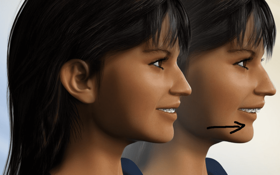 Digital illustration showing before and after Treatment for Overbite with jaw repositioning at Limestone Hills Orthodontics in Austin, TX.