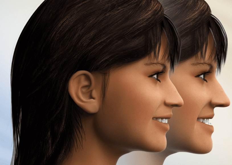 Digital illustration showing before and after Treatment for Underbite through orthodontic care and jaw surgery at Limestone Hills Orthodontics in Austin, TX.