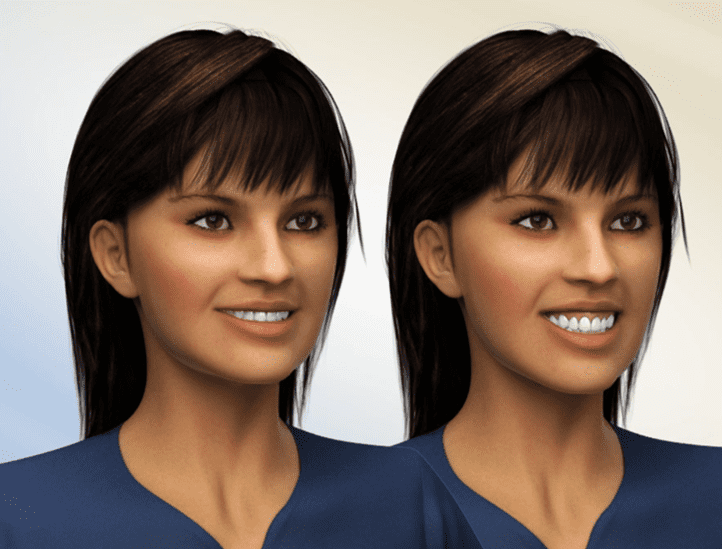 Frontal view before and after maxillary impaction jaw surgery for Treatment of Gummy Smile and Overbite at Limestone Hills Orthodontics in Austin, TX.