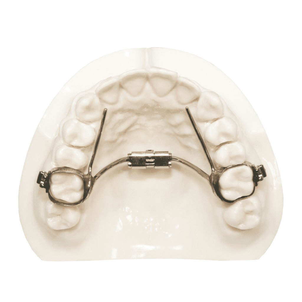 Dental model with mini rapid palatal expander, comparing braces vs clear trays. Limestone Hills Orthodontics, Austin TX.