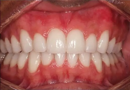After braces treatment with bite-pads showing corrected overbite alignment
