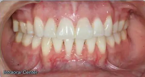 After braces, extractions, and myofunctional therapy showing a corrected open bite with aligned teeth