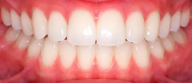 After Invisalign treatment showing improved tooth alignment