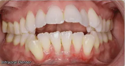 Before braces and myofunctional therapy showing an open bite with misaligned teeth