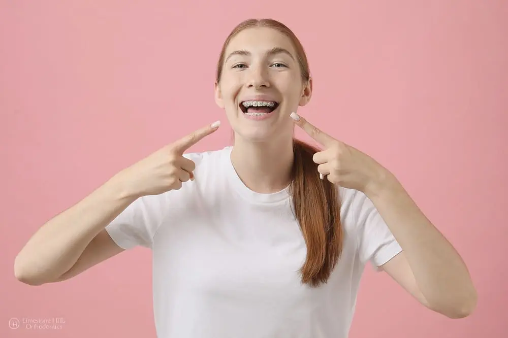 Self-ligating braces that reduce friction and offer comfortable tooth movement at Limestone Hills Orthodontics in Austin, TX.