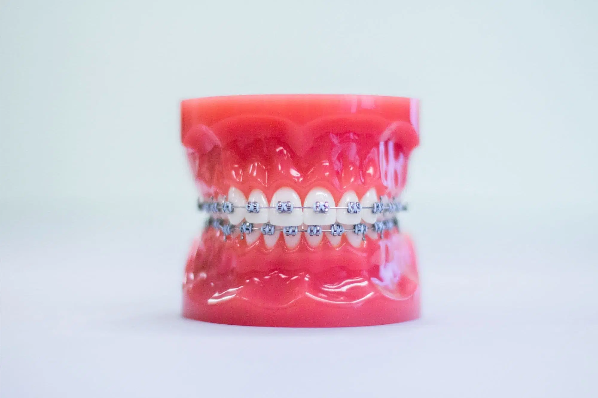 "A dental model showing upper and lower teeth fitted with stainless steel metal braces, illustrating the role of stainless steel brackets. Limestone Hills Orthodontics in Austin, TX, offers expert traditional braces treatment
