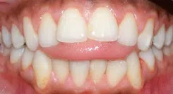 When do kids get braces?