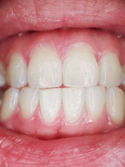 Close-up of straight, healthy teeth showing zero overbite and zero overjet, example from Limestone Hills Orthodontics in Austin, TX.