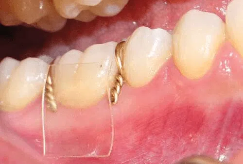 Brass wire spacer placement for orthodontic space creation for band placement