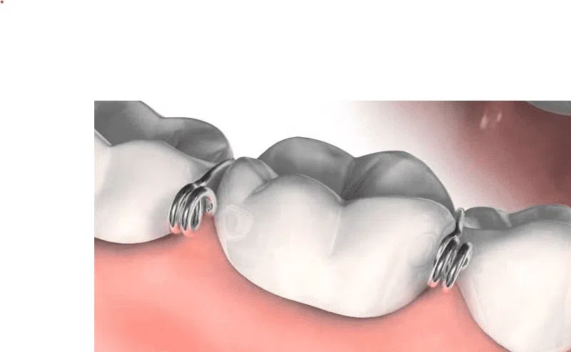 Metal dental spacers preparing space for metal bands.