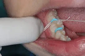 Inserting and removing spacers process