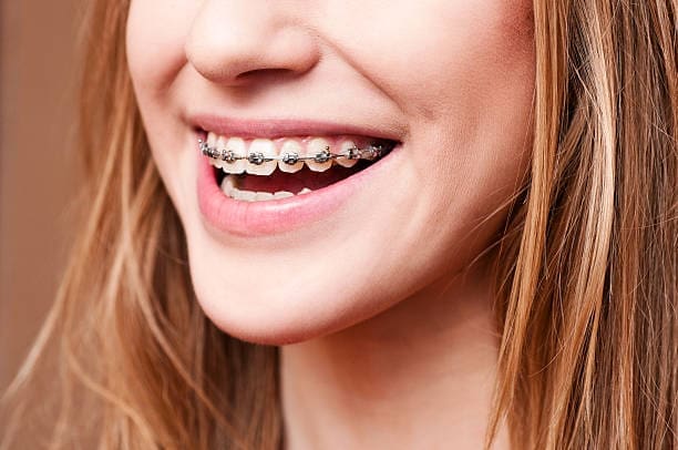 Close-up view of a woman's smiling face, showcasing her teeth with metal braces. This image likely depicts the orthodontic treatment provided by Limestone Hills Orthodontics in Austin, TX, to correct an overbite or other dental alignment issues.