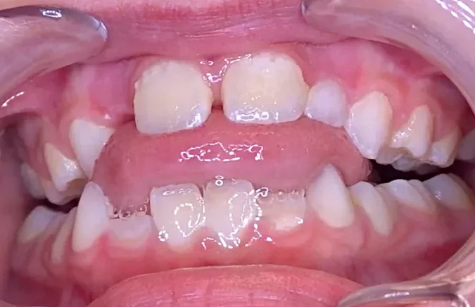 Close-up of a child’s open bite malocclusion showing what causes tongue thrust, treated at Limestone Hills Orthodontics in Austin, TX.